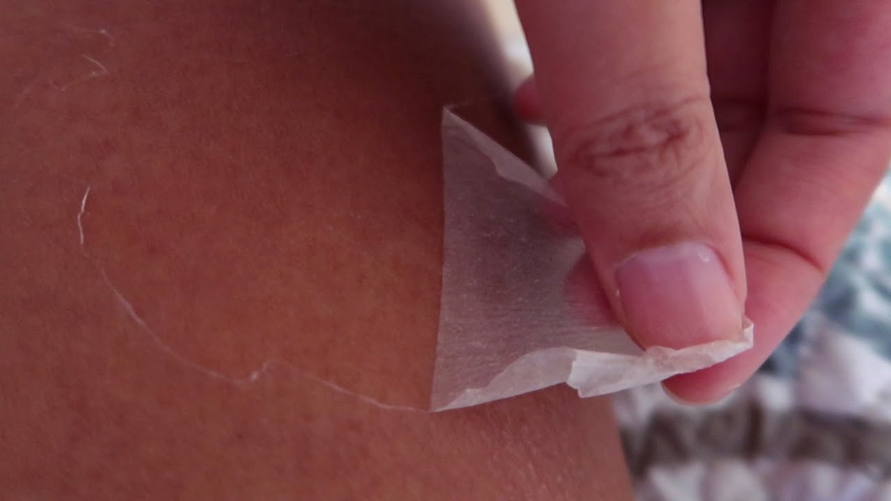 Zadowalający peeling sk&oacute;ry po oparzeniach słonecznych cz. 2