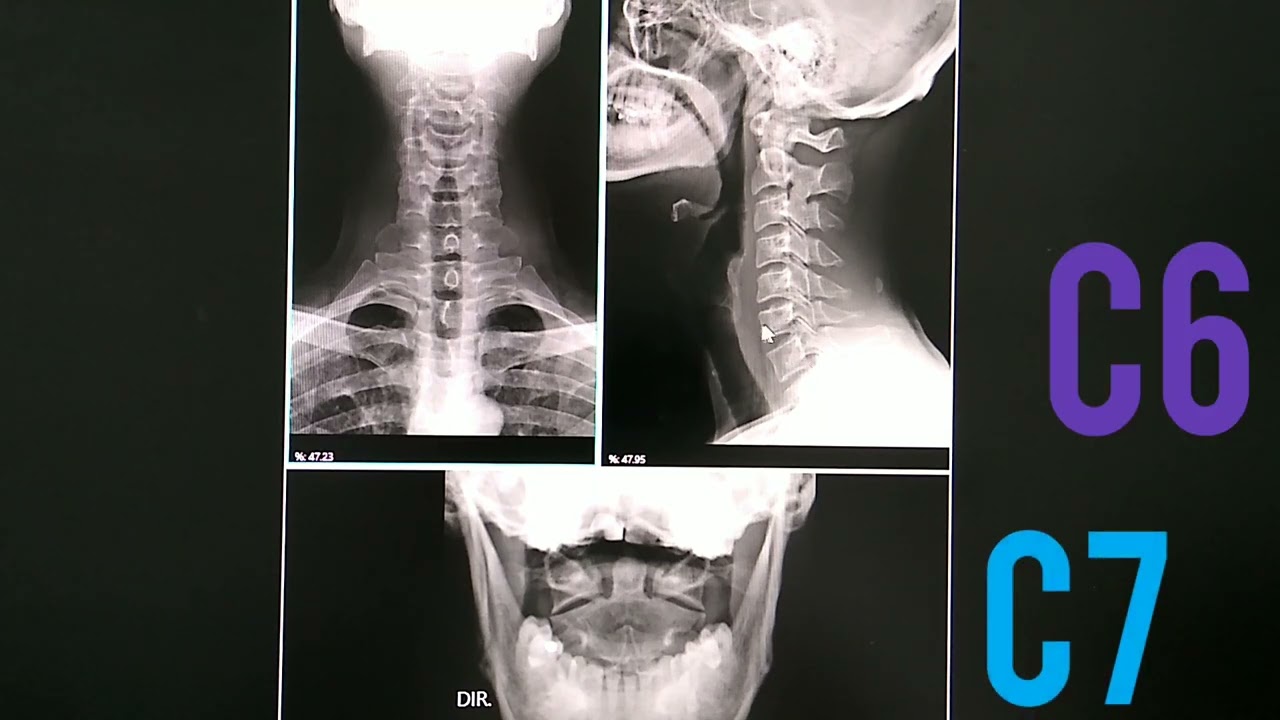 Coluna Cervical, Anatomia Radiologica.
