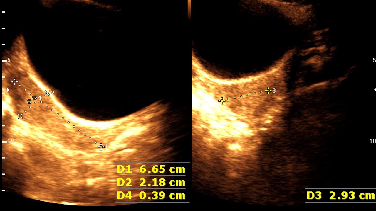 Ultrasound cases 340 of 2000 || Precocious puberty