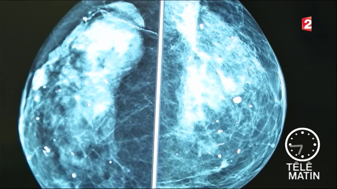Santé - Lutter contre la récidive du cancer du sein