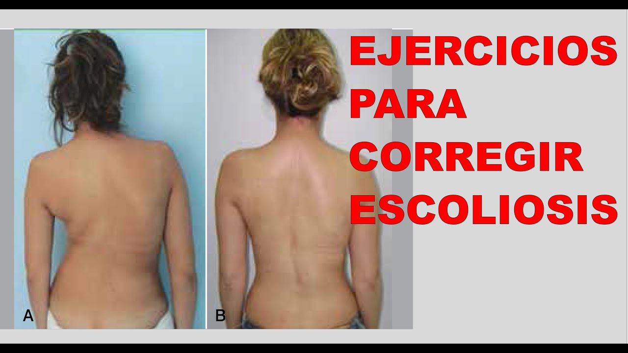 Cómo corregir escoliosis
