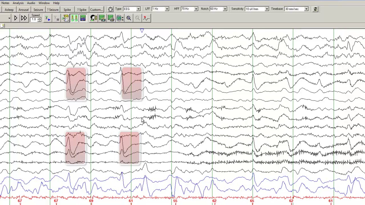 Learn to Read EEGs Part - 4