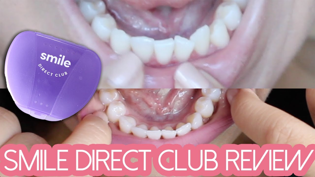 SMILE DIRECT CLUB REVIEW: Final Thoughts