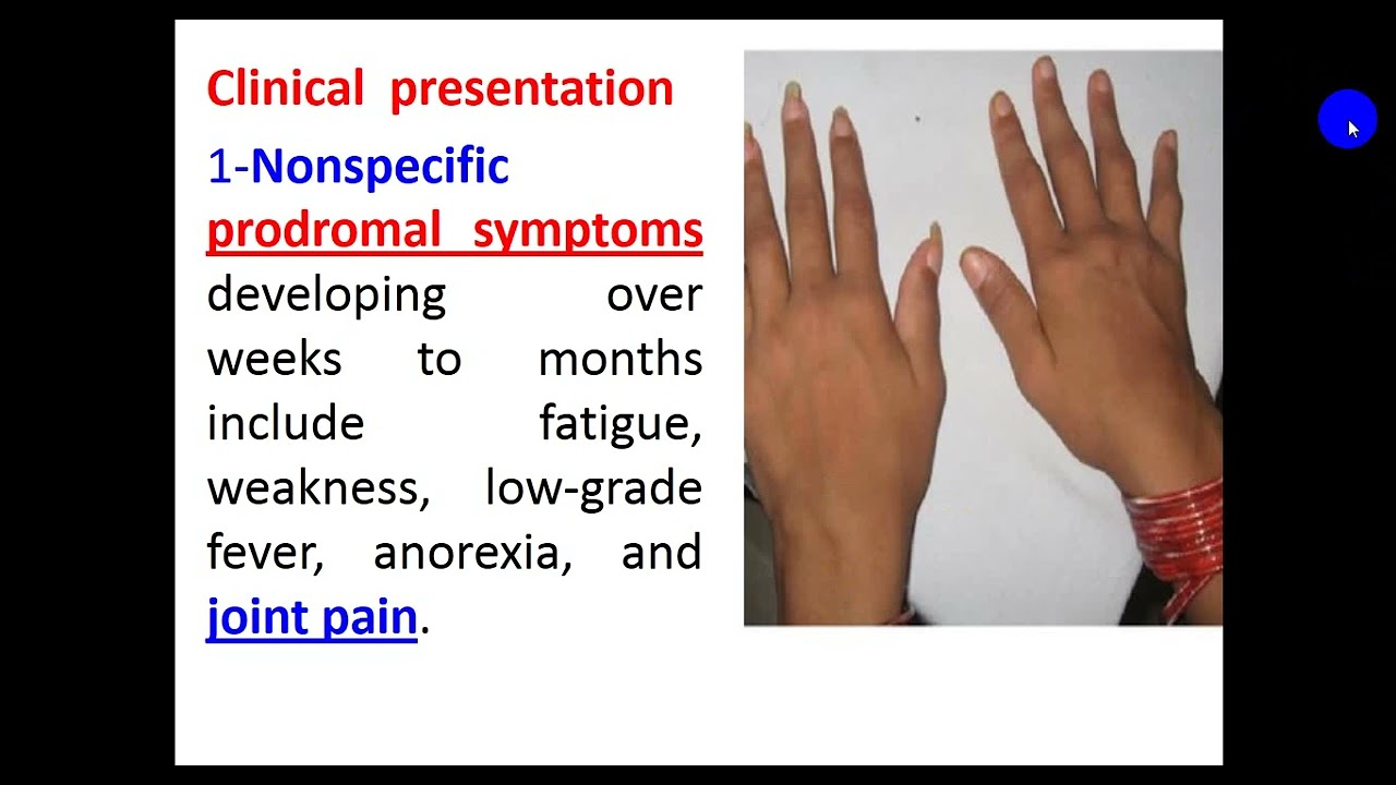 Rheumatoid Arthritis 2024 By Dr  Dheyaa Jabbar