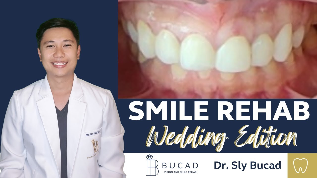 WEDDING SMILE REHAB #SMILEREHAB #SMILE #crowns
