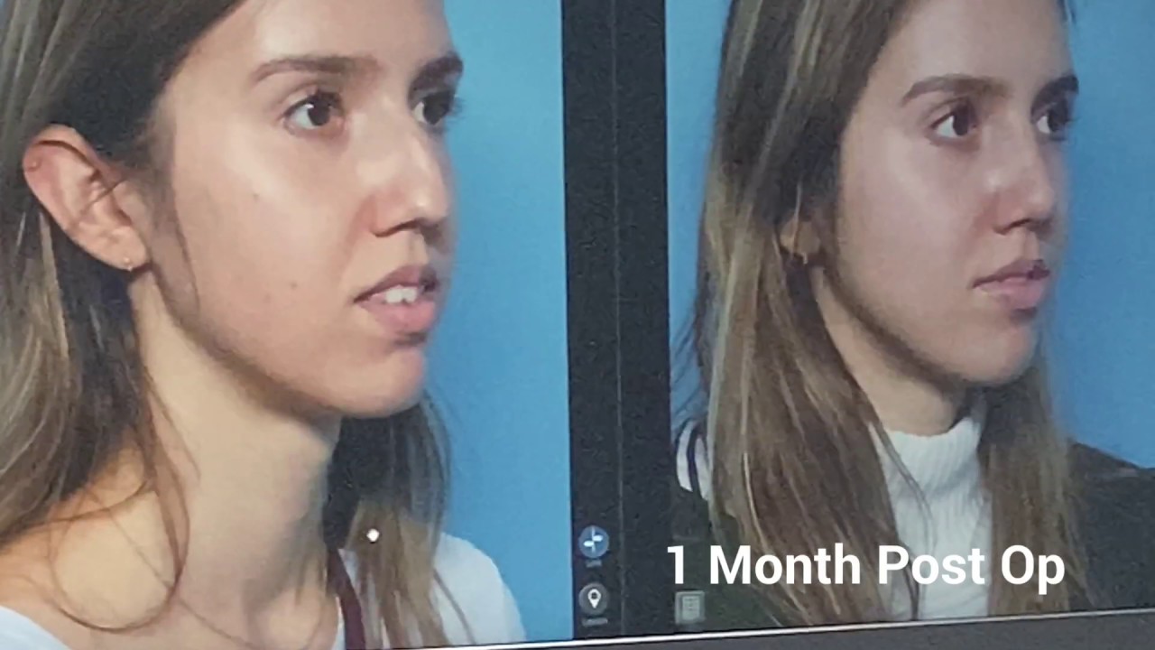 Rhinoplasty 3D Software | Board Certified Facial Plastic Surgeon