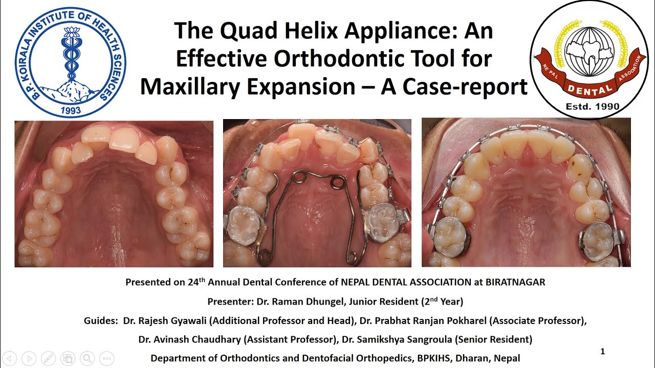 The Quad Helix Appliance: An Effective Orthodontic Tool for Maxillary Expansion – A Case-report