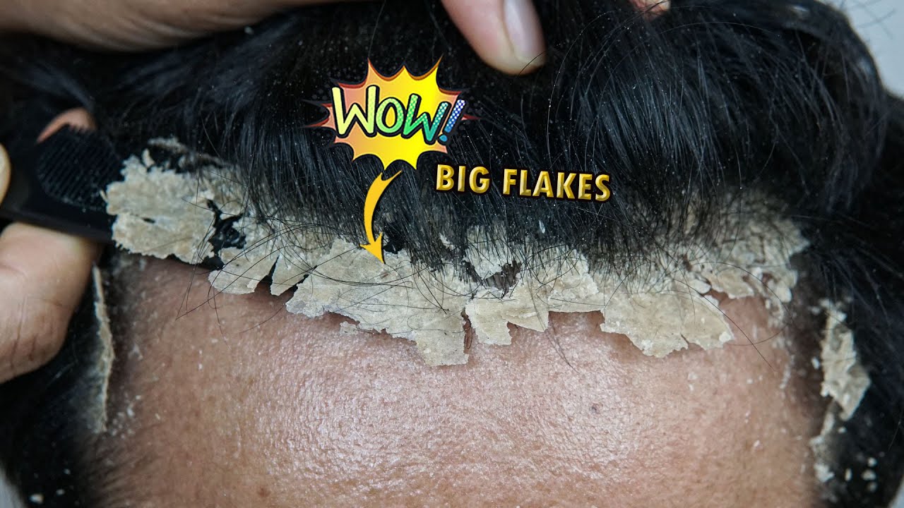 Scratching Big Dandruff Flakes Satisfying #1198