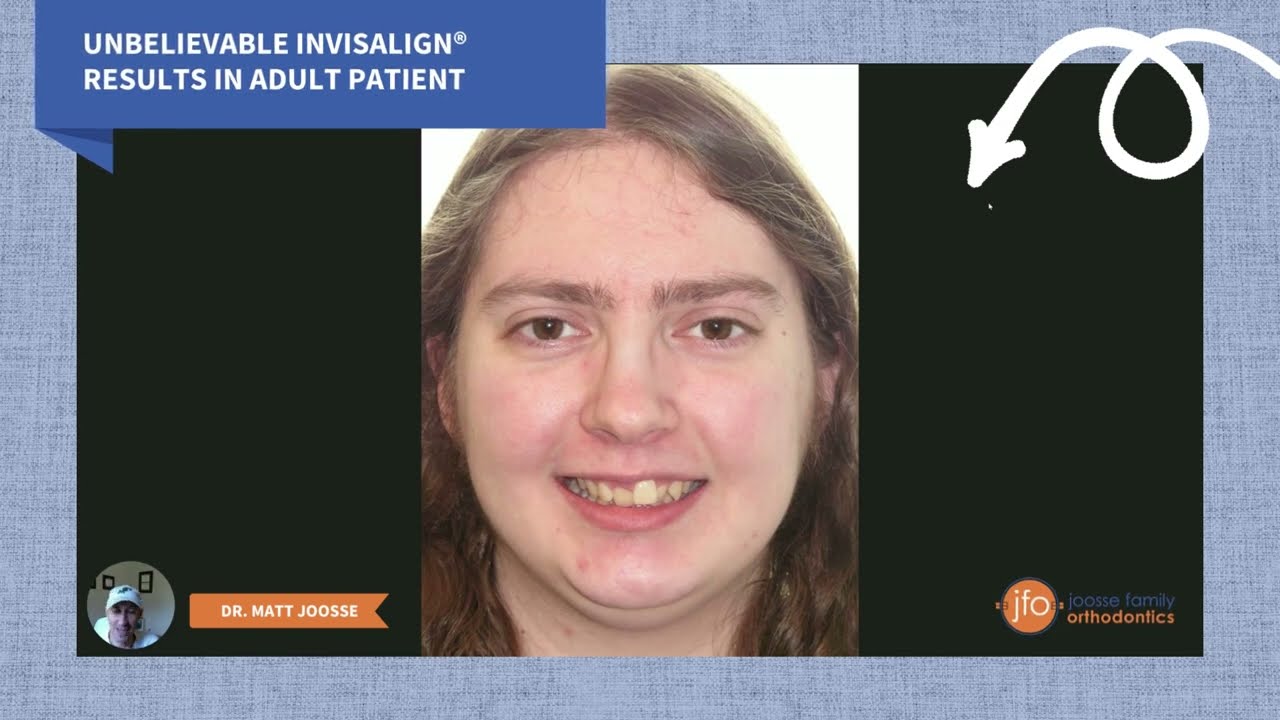Unbelievable Invisalign Results in Adult Patient! | Joosse Family Orthodontics | Williamsburg, VA