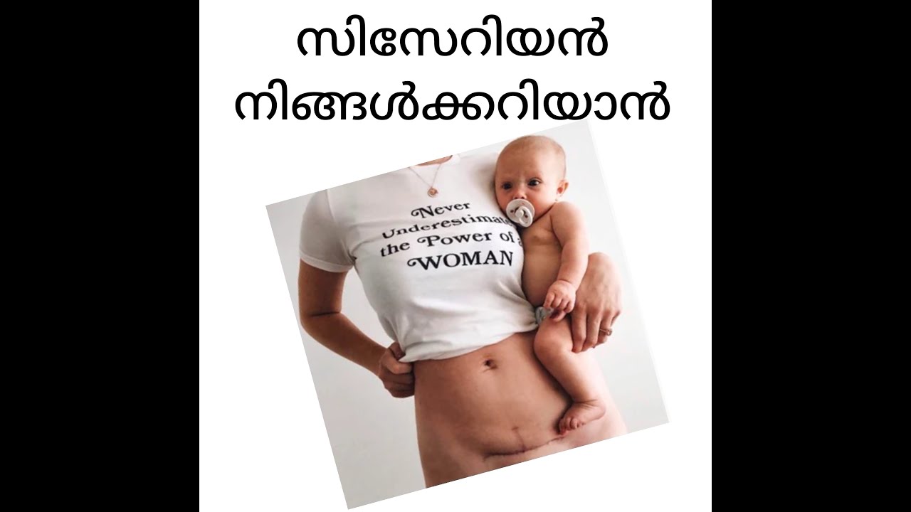 caesarean section