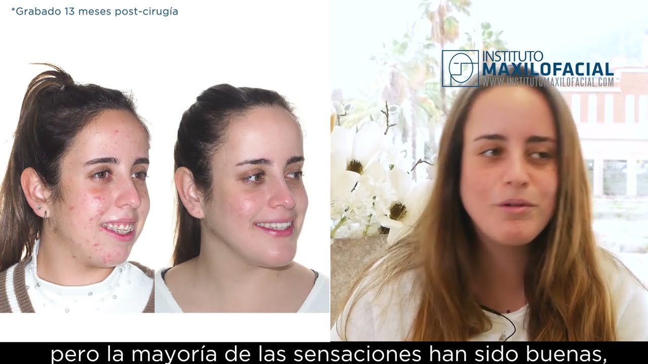 Cirug&iacute;a ortofacial. Caso # 97: Cristina - Sonrisa gingival, biretrusi&oacute;n, incompetencia labial