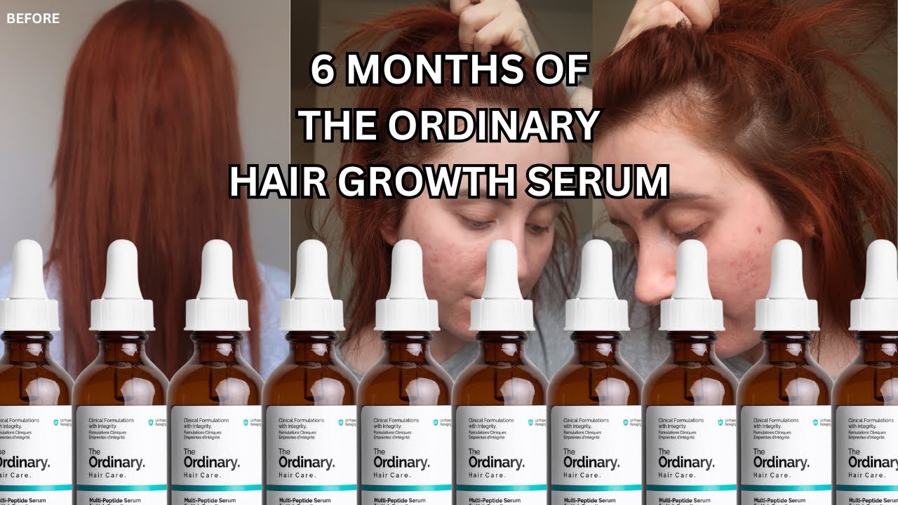 6 Months of The Ordinary Hair Growth Serum