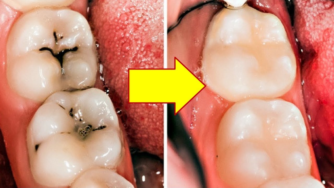 7 Simple Ways to Naturally Reverse Cavities and Heal Tooth Decay! You Need To See This!
