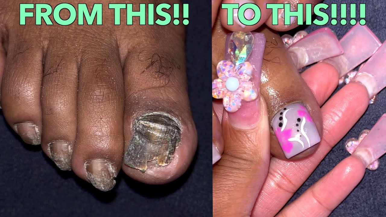 EXTREME ACRYLIC TOE TRANSFORMATION! | ACRYLIC TOE TUTORIAL!