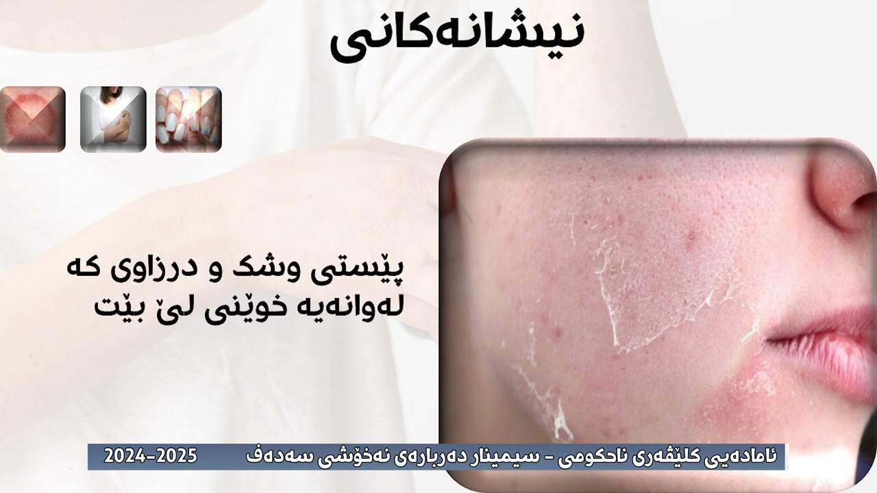 ئامادەیی كلێڤەری ناحكومی   سیمینار دەربارەی نەخۆشی سەدەف