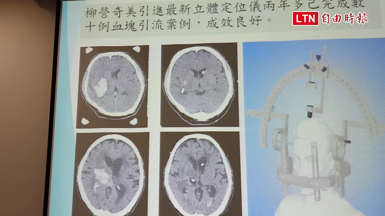 腦出血免開顱 立體定位引流血塊