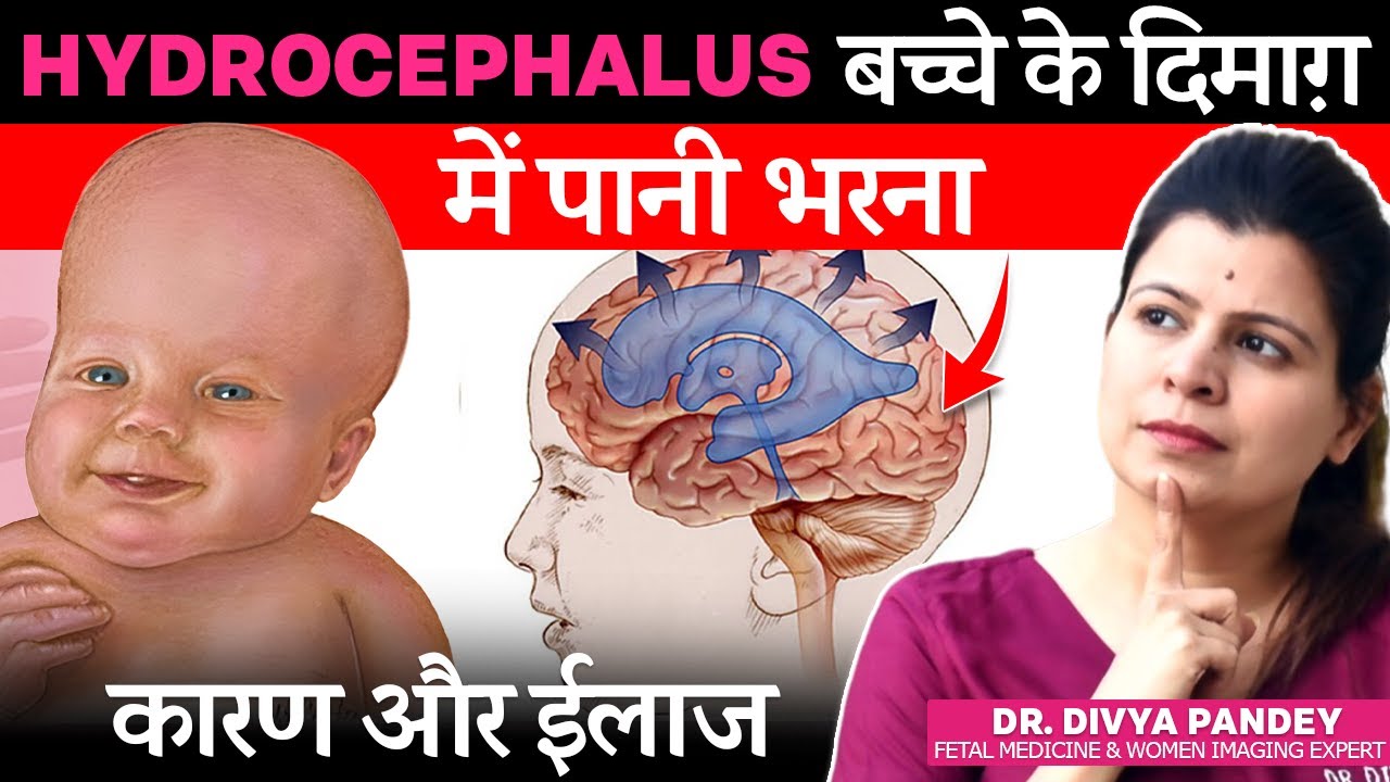 Bache Ke Dimaag Mein Pani Kyu Bhar Jata Hai?  | Hydrocephalus Hone Ka Karan Aur Ilaaj?