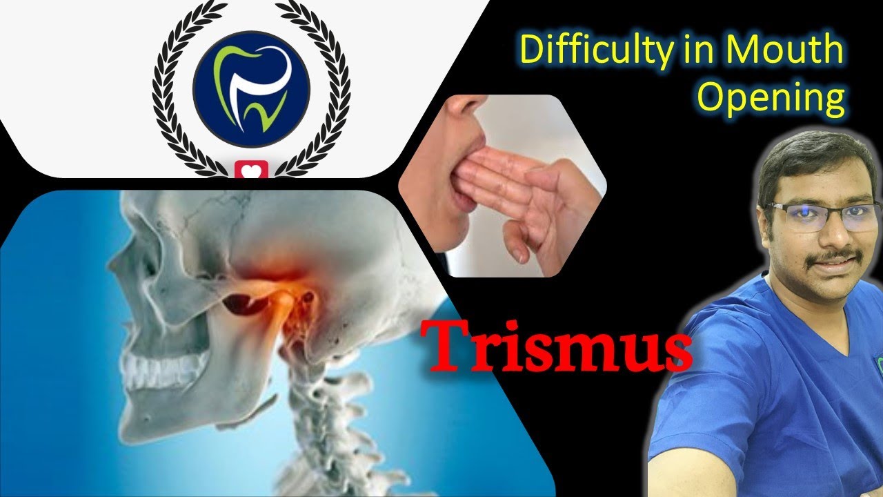 Dr Rudra Mohan | DIFFICULTY IN MOUTH OPENING ?| Dr Rudra's Dental Clinic| Trismus| Locking of Jaw