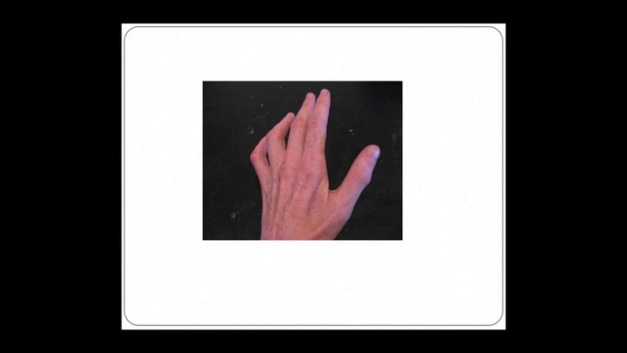 Neurology - neuropathy
