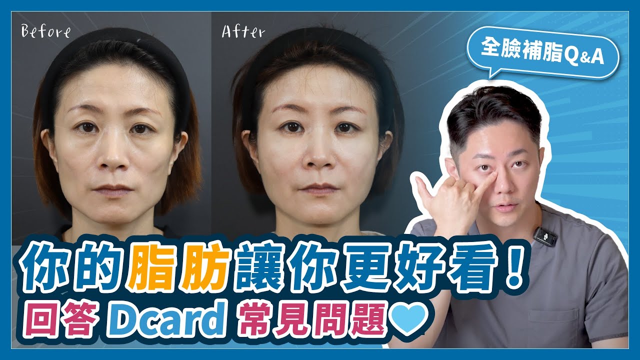 「全臉補脂」你的脂肪讓你更好看！回答Dcard常見問題💙｜台南杰美學 周杰醫師