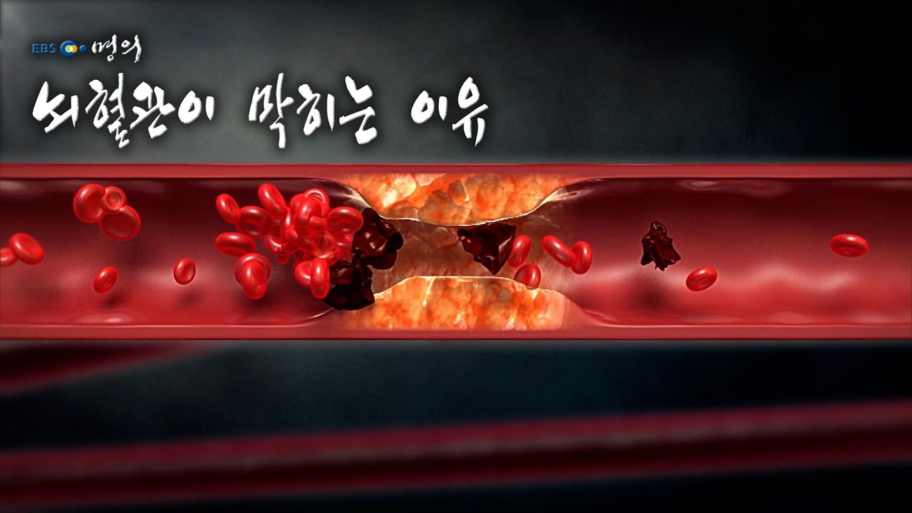 [명의 의학백과📖] 뇌혈관이 막히는 이유