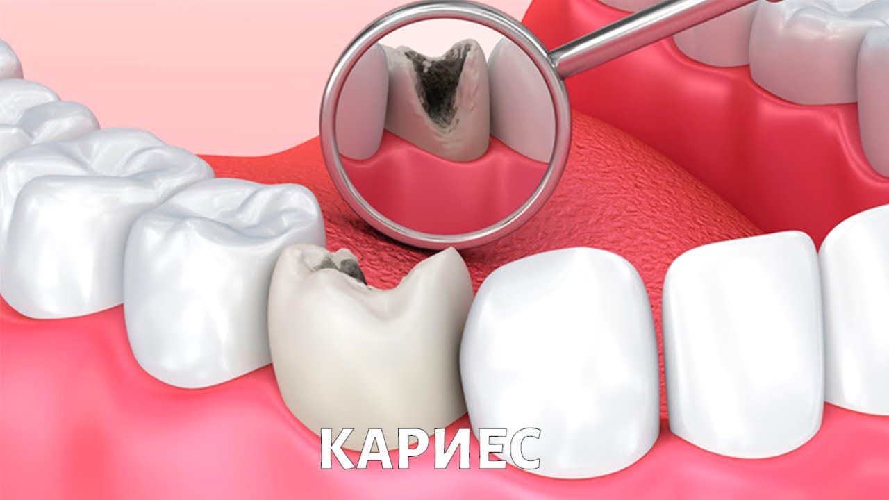 Что такое КАРИЕС?