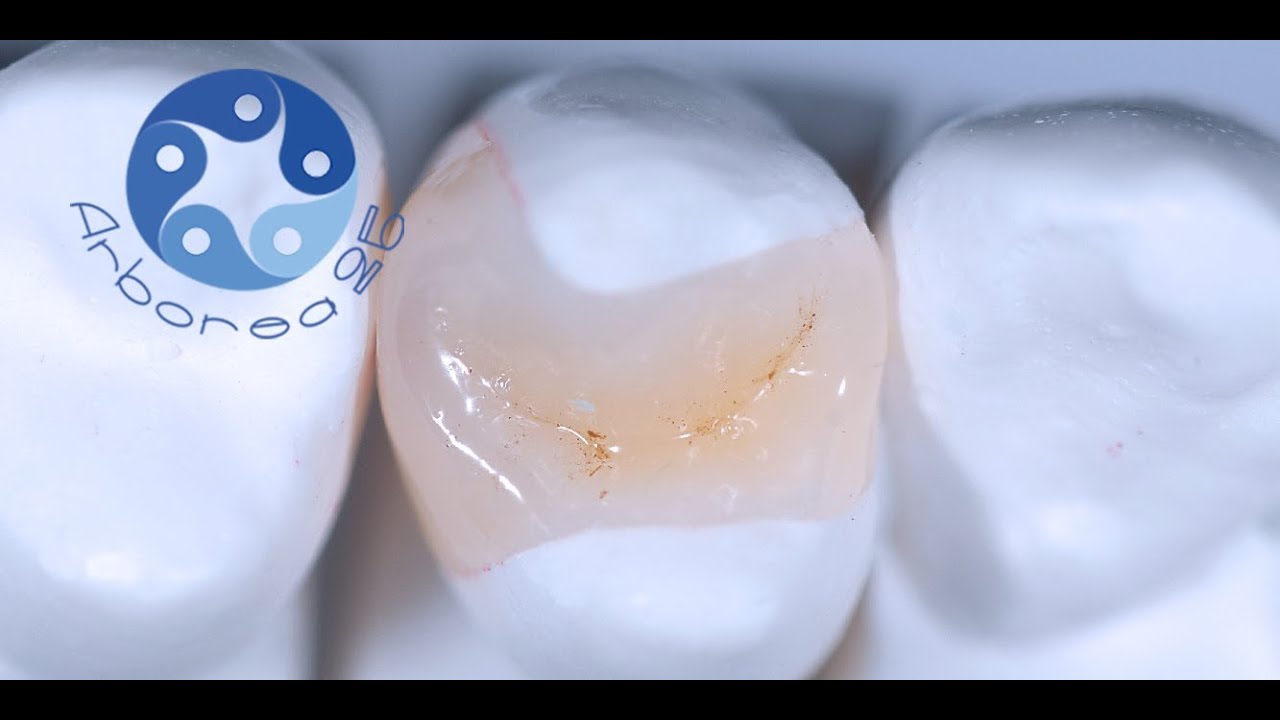 Intarsio dentale. Quando viene utilizzato e perché?
