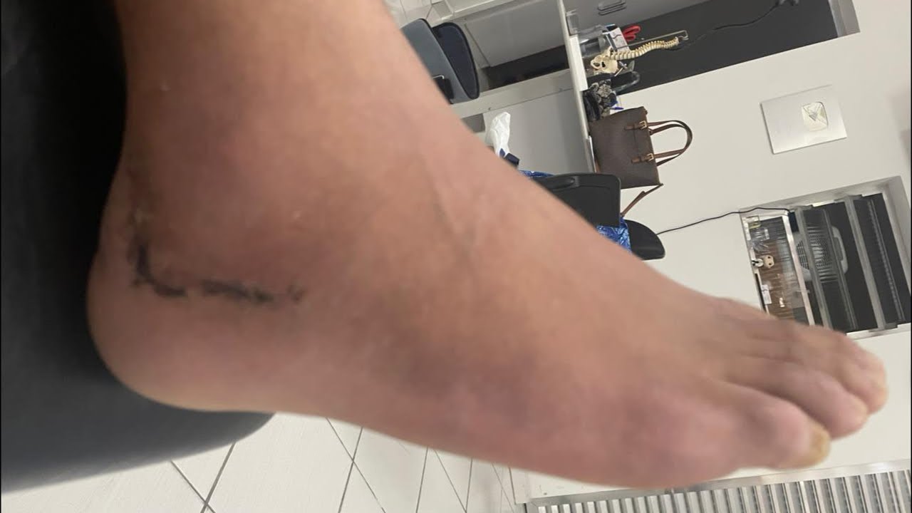 Fratura no Calcanhar – Como Recuperar os Movimentos e Voltar a Andar | Fisioterapia Dr. Robson Sitta