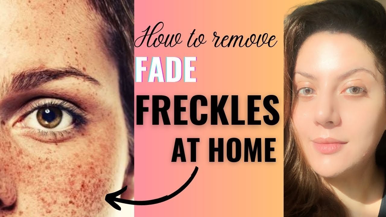 How to fade freckles on face naturally I Treatment for freckles on face #frecklestreatment