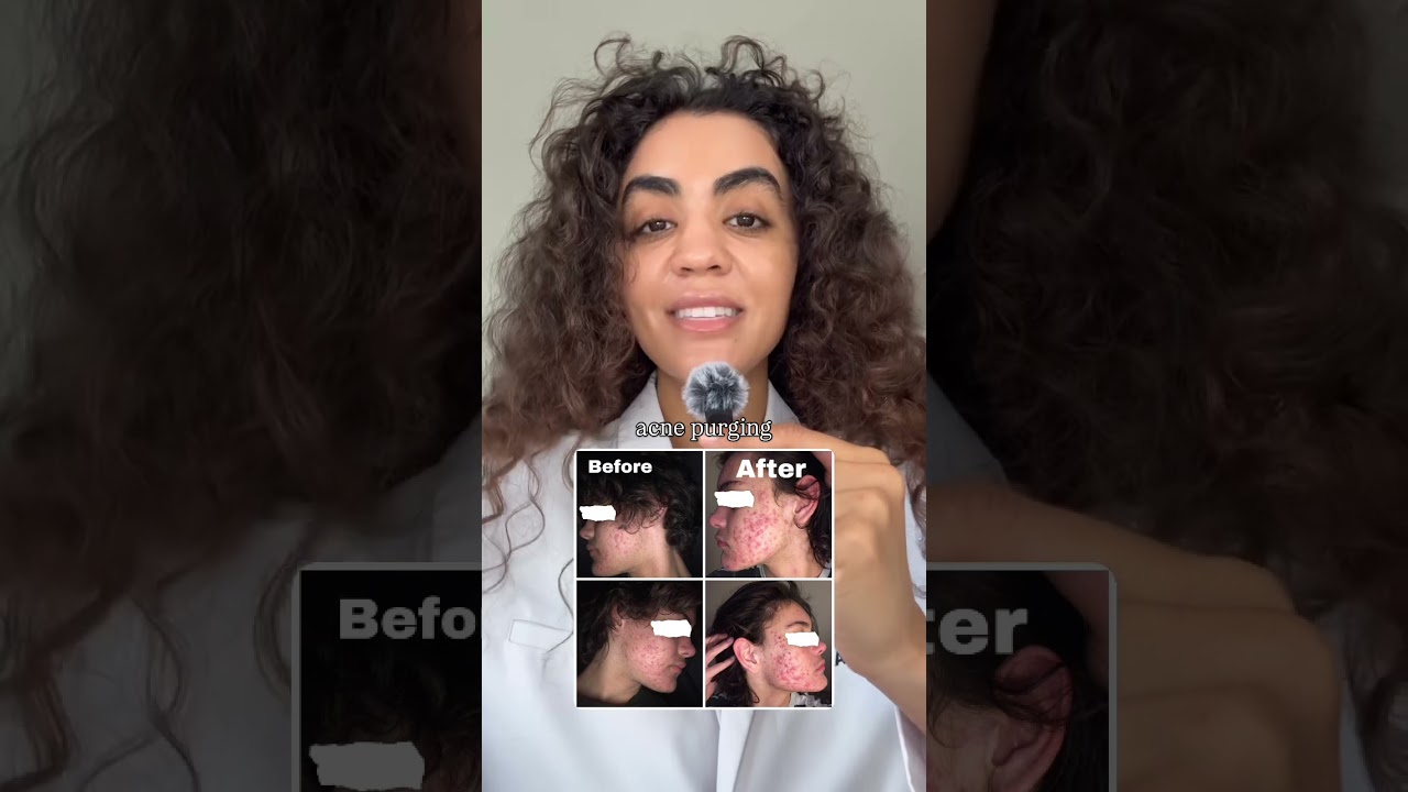 Oral isotretinoin (Accutane) for acne #acne #accutane #isotretinoin #acnepurging #acnescars