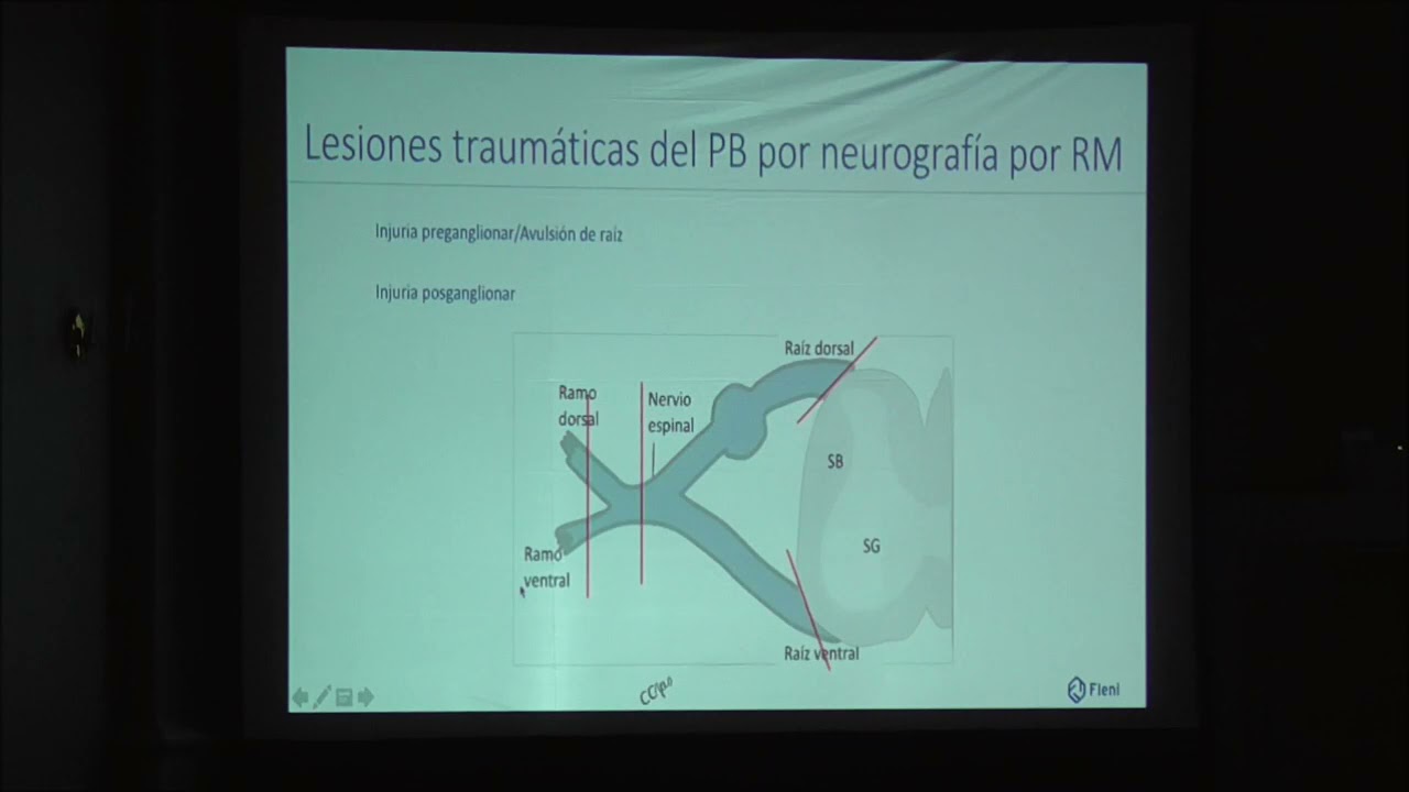 Neurografía de plexo braquial: generalidades. Claudia Cejas