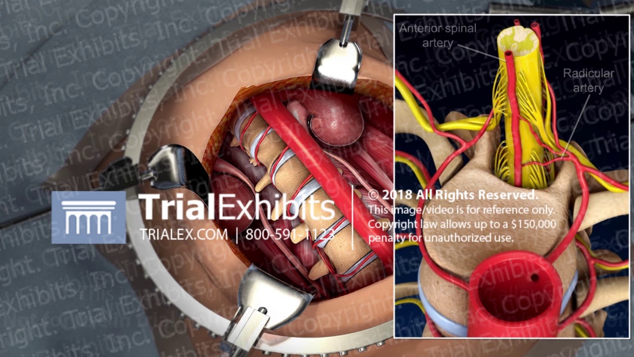 Complications of Open Abdominal Surgery