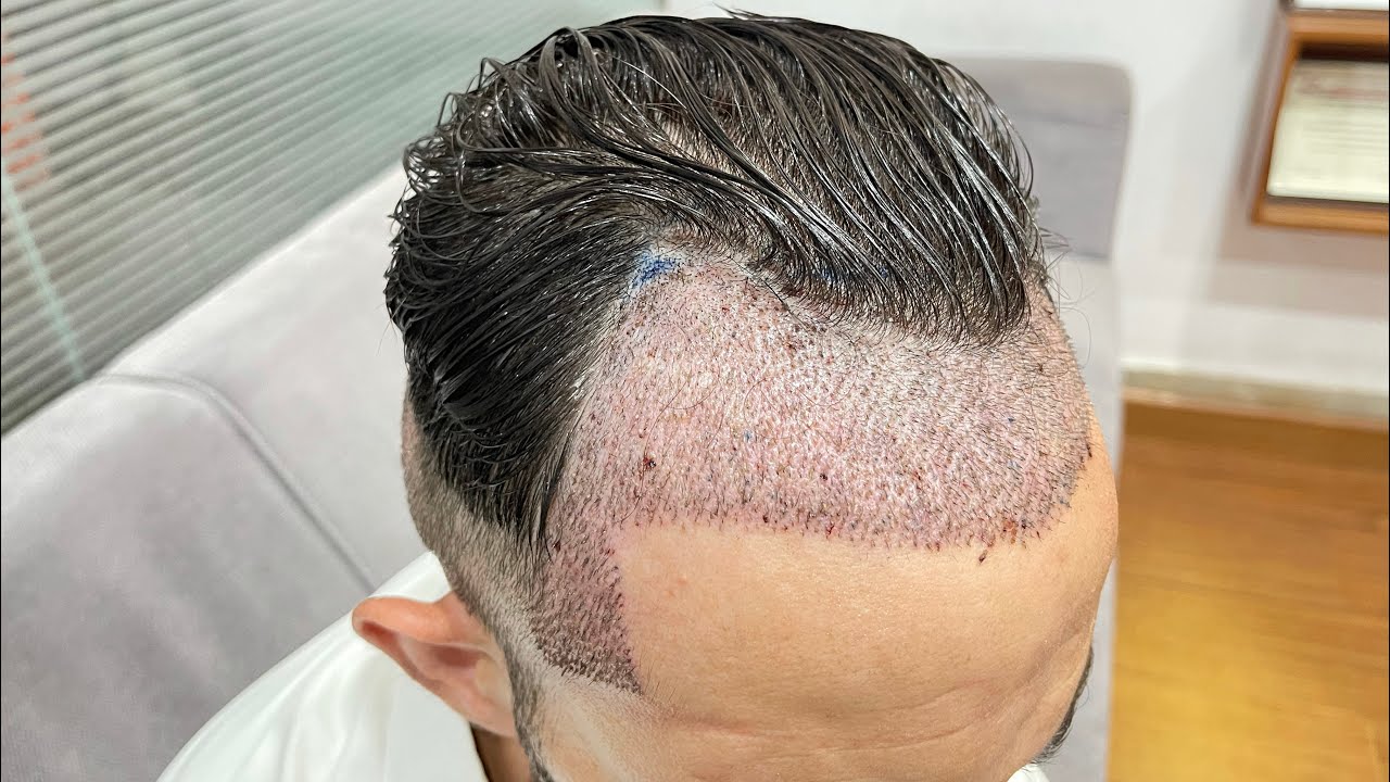 What u need before hair transplant for Good results | Requirments before hair transplant