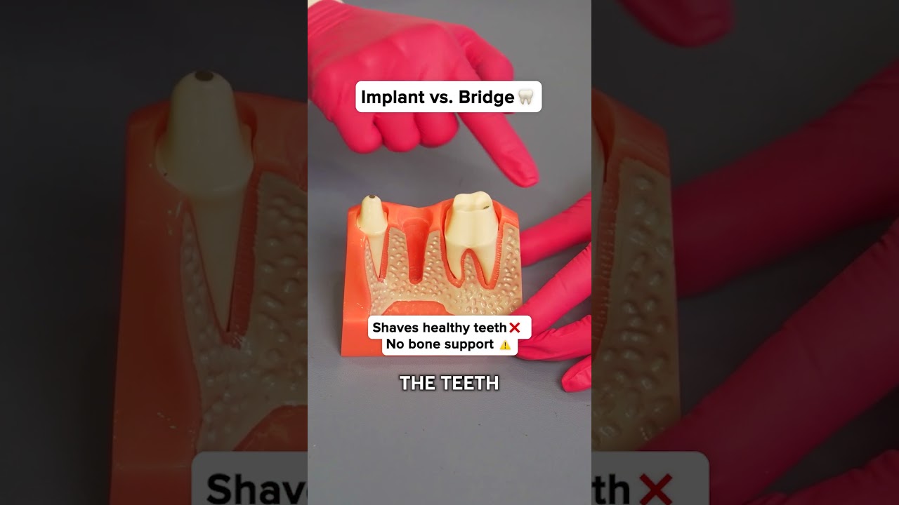 Implant vs. Bridge 🦷 Which one&rsquo;s really better? 🤔