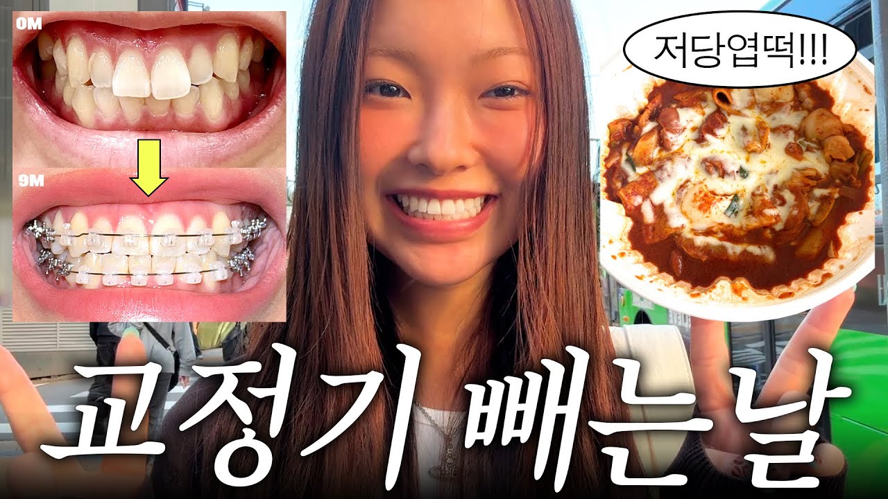 드디어 교정기 제거...🥵 교정기 빼고 엽떡으로 폭주하는 브이로그🦷💥 (+유지장치 후기^^.....)