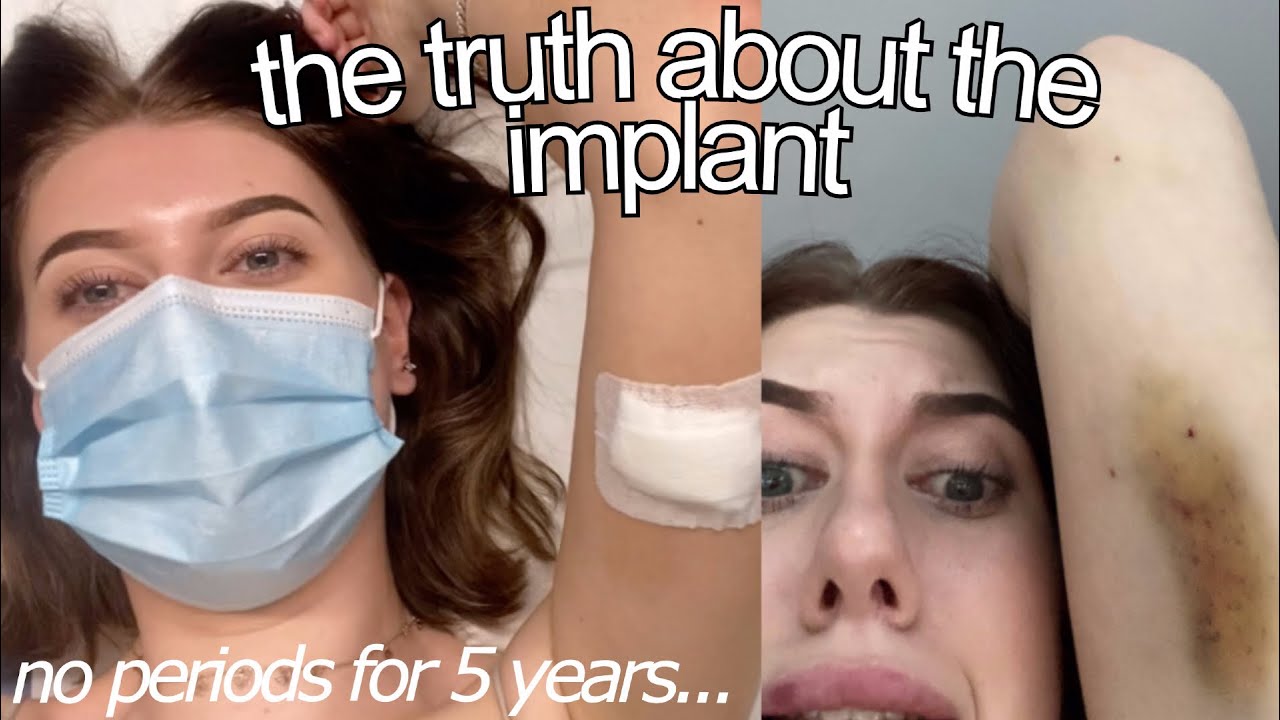 getting my implant removed AND REPLACED after 5 years (my experience)