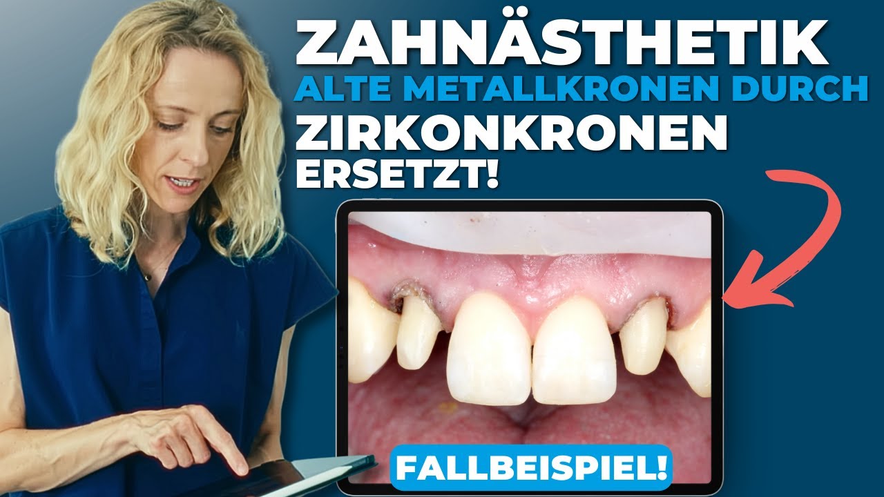 Ästhetische Verbesserung: Alte Metallkeramikkronen durch Zirkonkronen ersetzt | Fallbeispiel