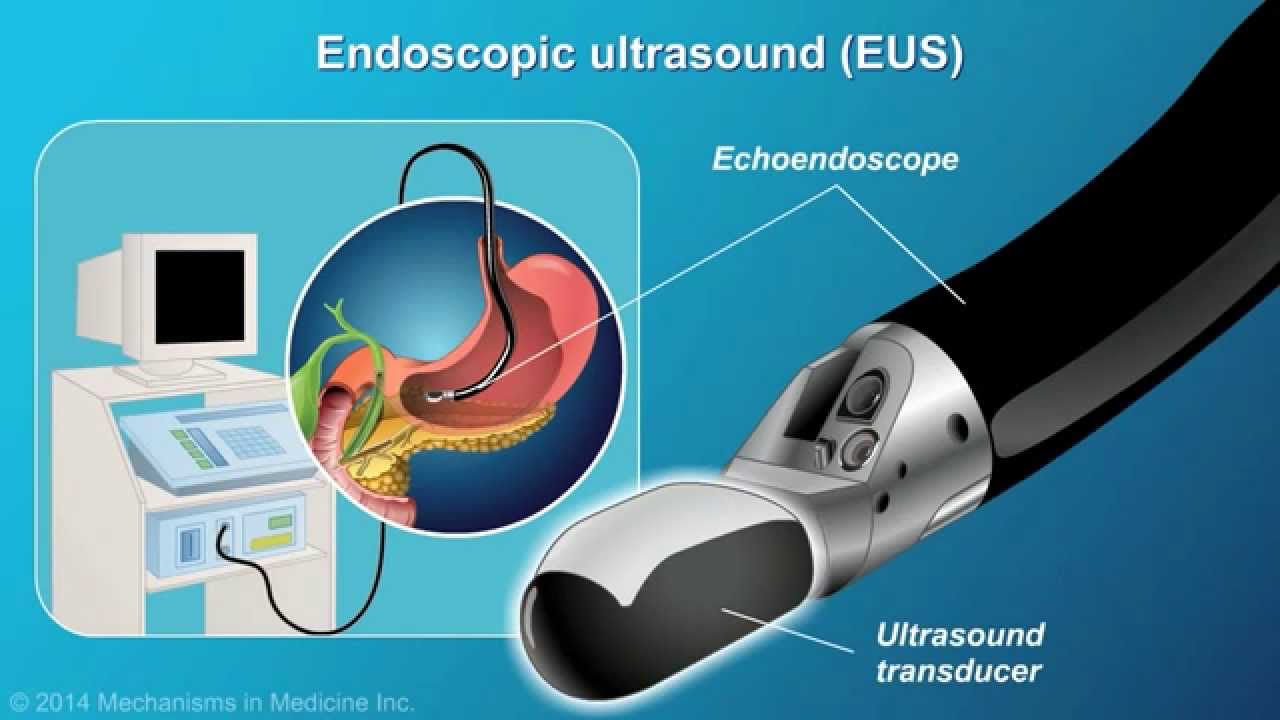 Понимание EUS-FNA