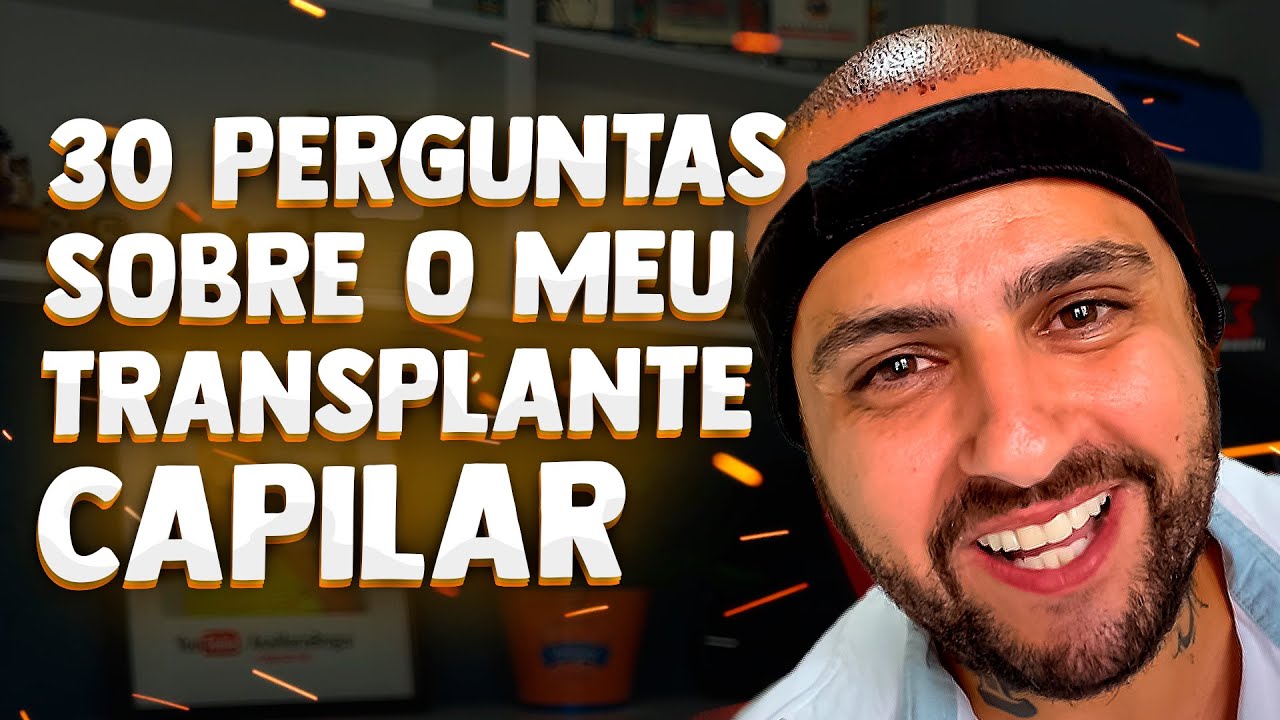 RESPONDI 30 perguntas sobre meu TRANSPLANTE CAPILAR | Preço, anestesia, fios, dor, tudo!
