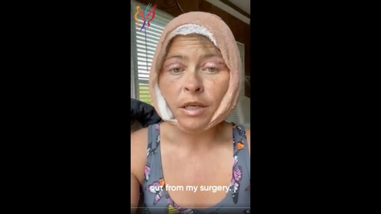 Miraculous Transformation A Real Patient's Journey to Radiant Youth - SMAS-DeepPlane Advanced Fa...