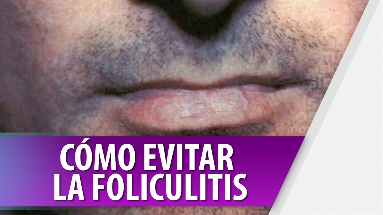 C&oacute;mo Evitar la Foliculitis