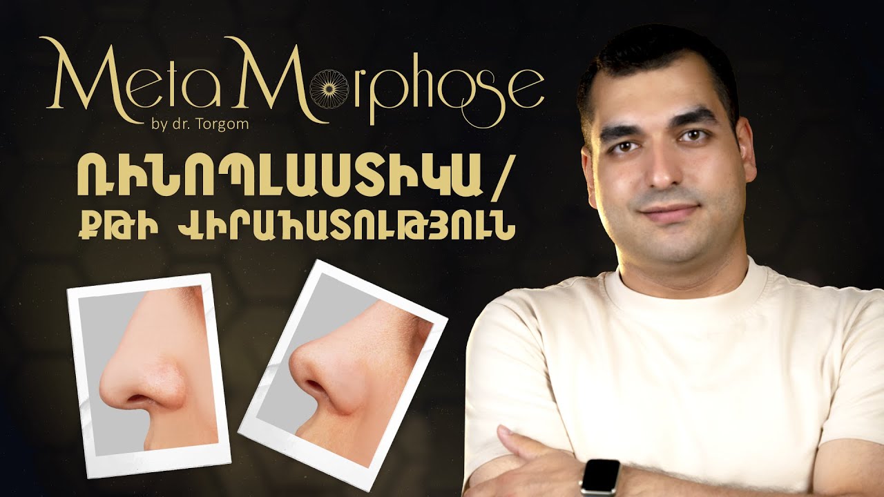 Քթի վիրահատություն | MetaMorphose 03