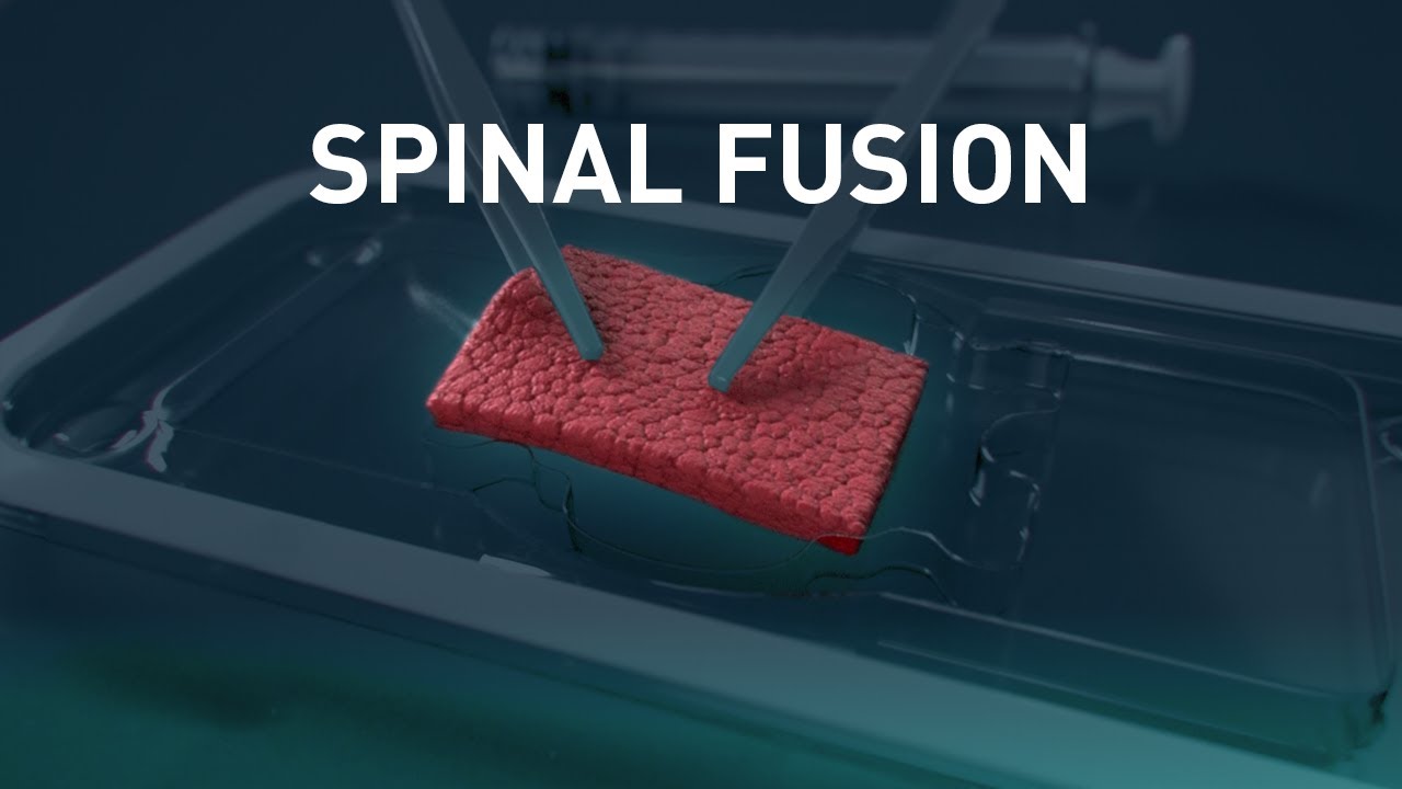 MagnetOs™ Flex Matrix | Medical Animation