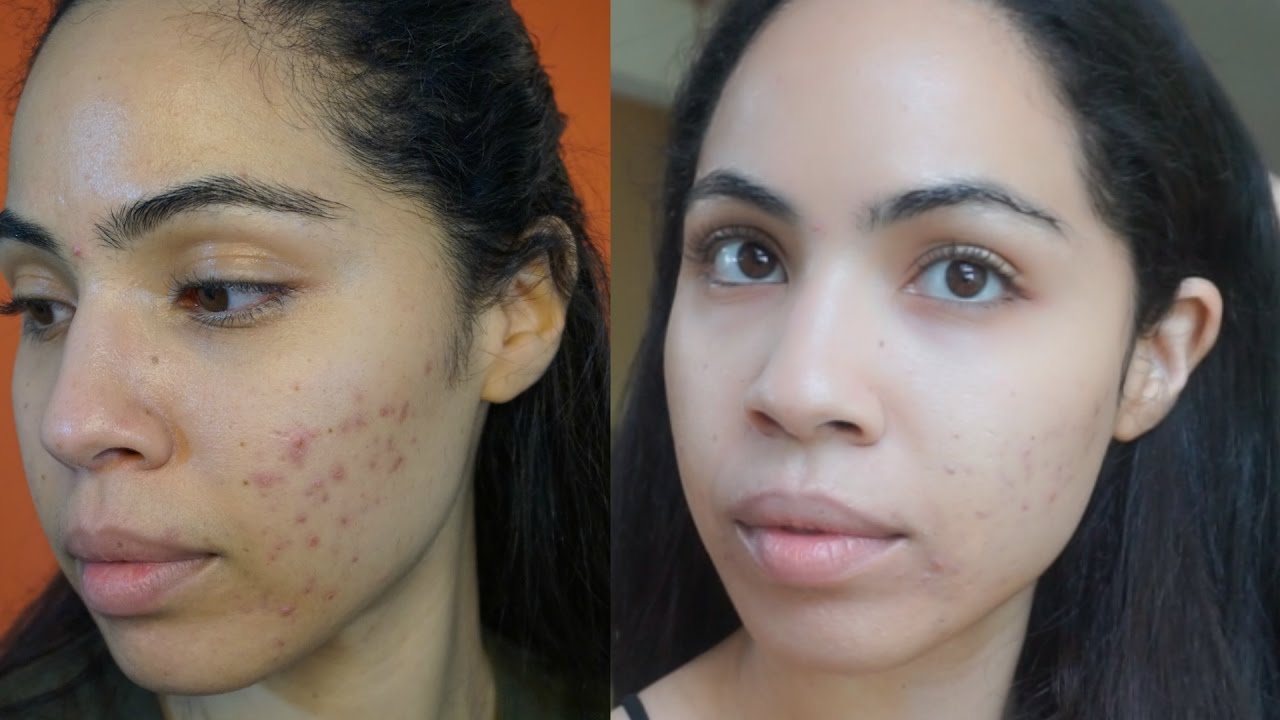 Acne Update - Clearing My Skin With Food