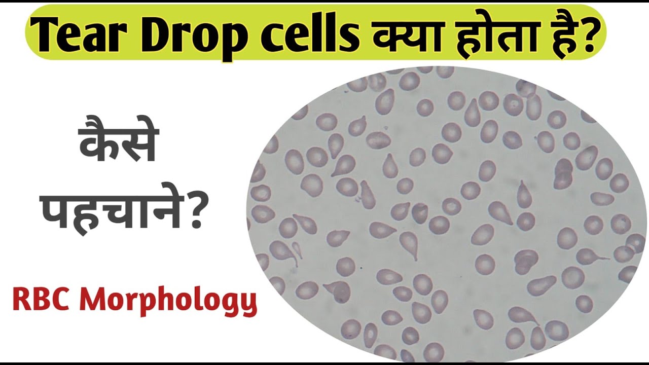 Tear drop cells II red blood cells