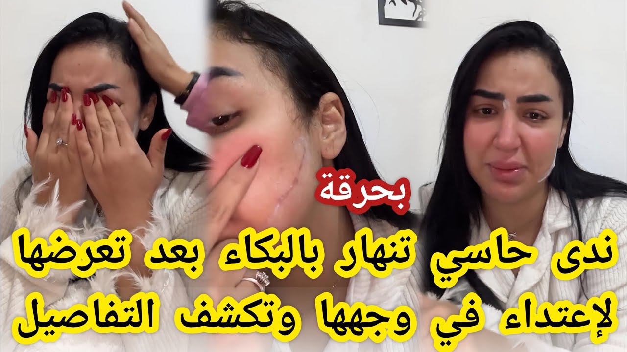 بحرقة🔴ندى حاسي تنهار بالبكاء بعد تعرضها لاعتداء في وجهها وتكشف التفاصيل