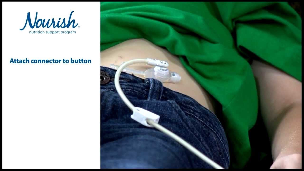 Home Tube Feeding for Children - Low Profile Feeding Tubes