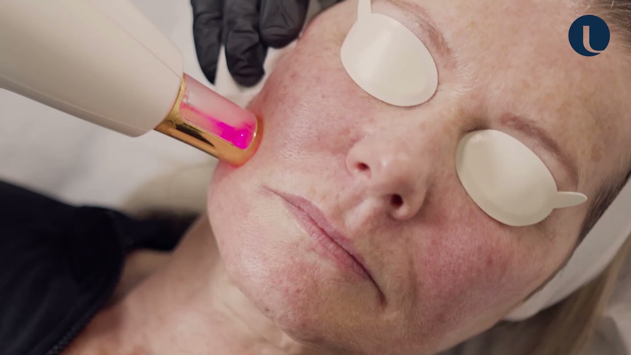 Resurfx fractional non-ablative skin resurfacing at Quinn Clinics Bristol