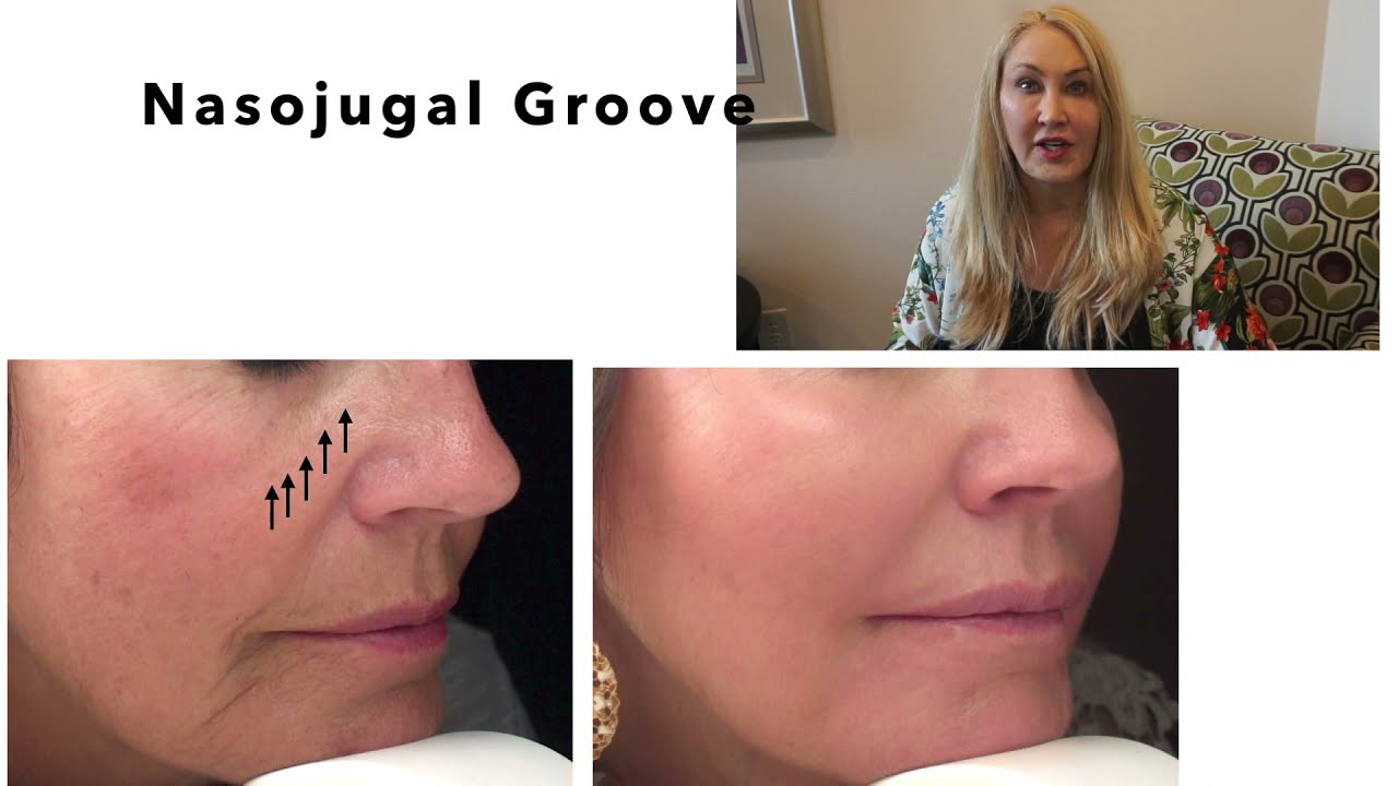 Marionette Lines | Cheeks | Nasojugal Groove