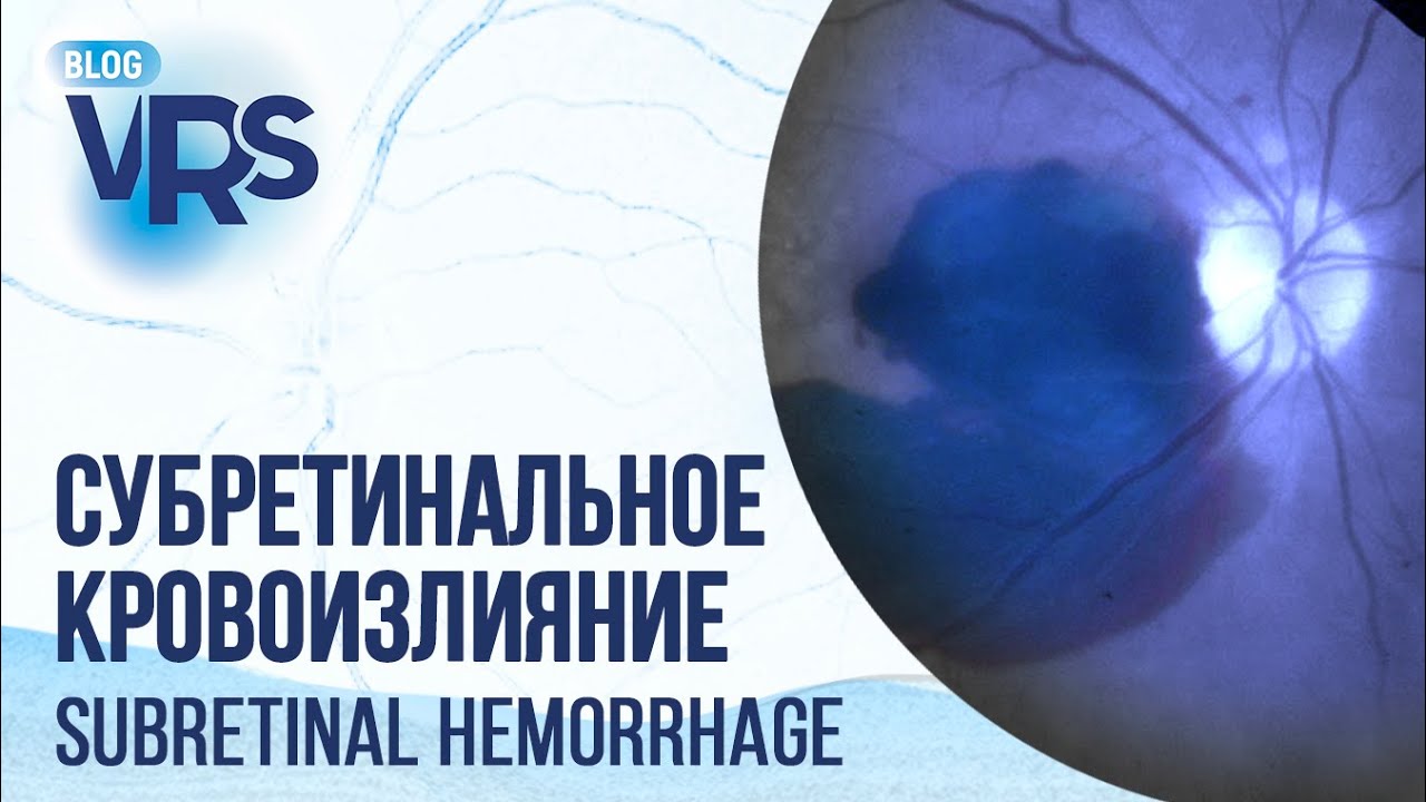 Субретинальное кровоизлияние. Лечение | Subretinal hemorrhage. Treatment